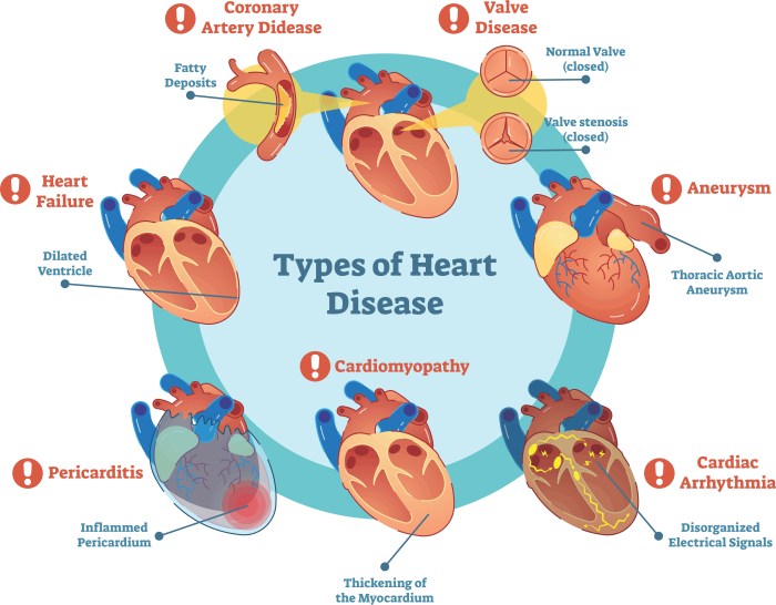 Disease cardiology issues